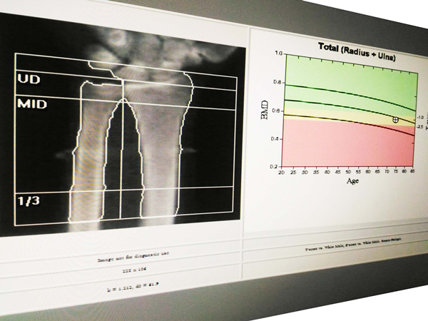 Picture of an Bone Density Scan procedure